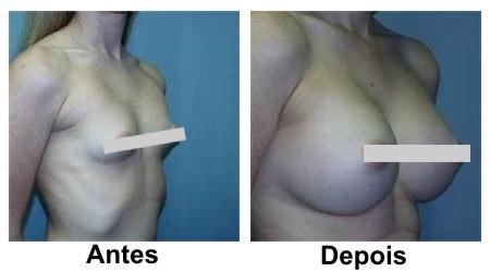 fotos plastica seios