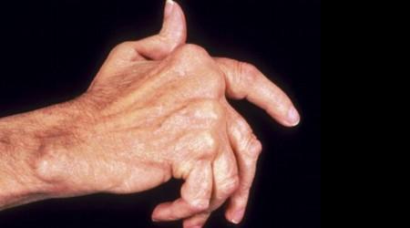 artrite mão artrítica