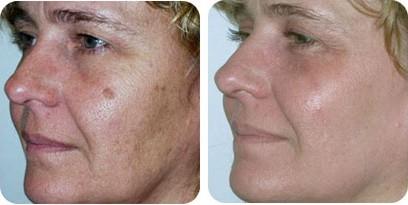 resurfacing com laser