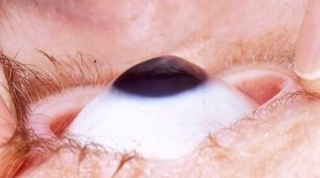 ceratocone
