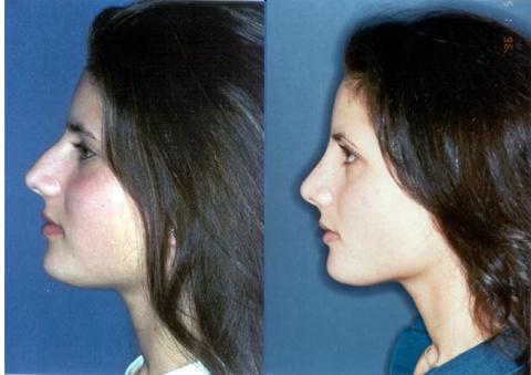 rinoplastia foto