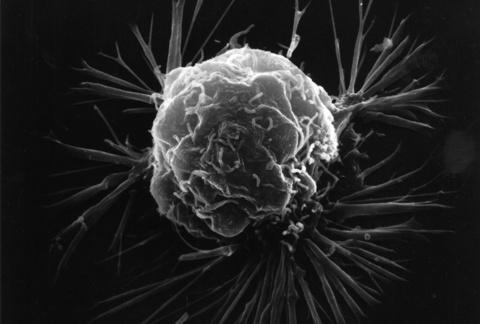 Imagem de uma célula de um câncer de mama feita em um microscópio de elétrons. Abaixo das células estão os vasos sanguíneos que ele forma para crescer.