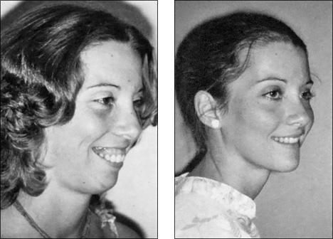 plástica antes e depois