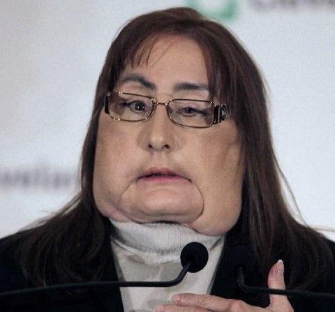 transplante de risco de connie gulp