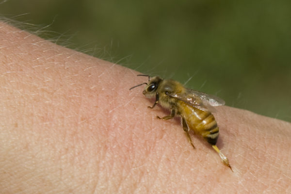 bee-sting-2
