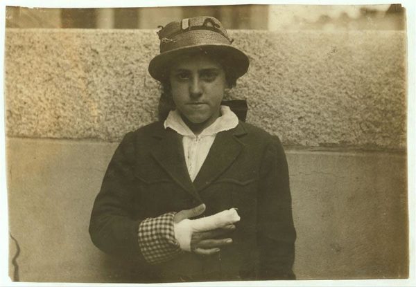 Aos 15 anos, Estelle Poiriere foi fotografada com uma grave lesão no dedo, que ficou preso em uma máquina