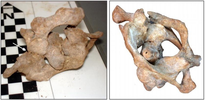 Os pesquisadores também descobriram que o arco posterior do osso atlas (a vértebra superior entre o crânio e a coluna vertebral) tinha sido quebrado