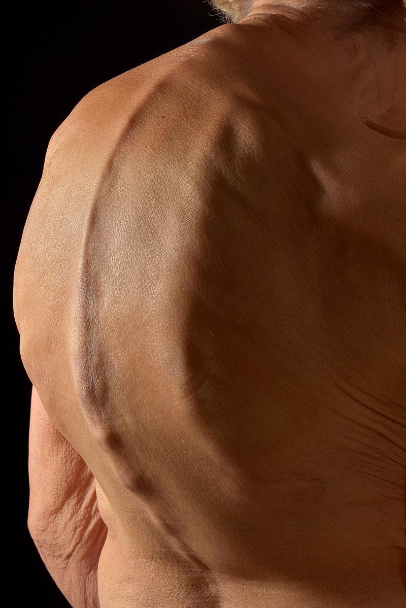 Mulher idosa com cifose (curvatura da coluna vertebral), por Mark Bartley, da Universidade Cambridge 