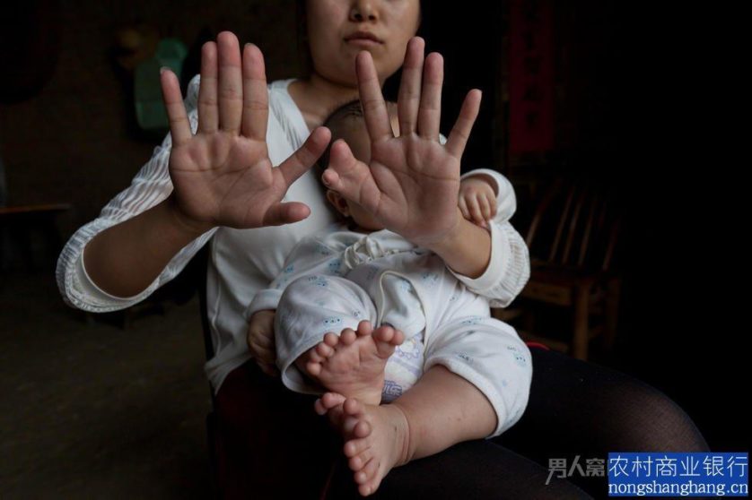 A mãe de Hong Hong tem polidactilia também, ela em seis dedos em cada mão