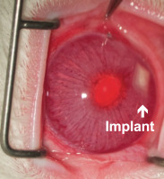 glaucoma-implante.jpg