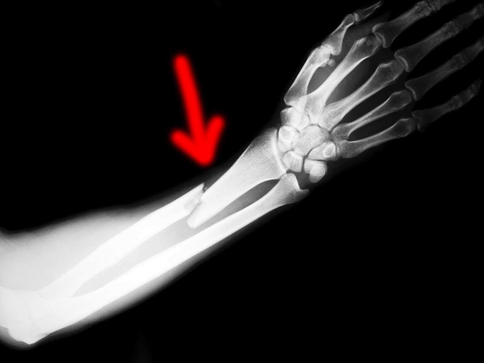 Переломы скелета. Перелом диафиза лучевой кости рентген. Перелом костяшки рентген. Открытый перелом предплечья рентген. Перелом диафиза лучевой кости руки.