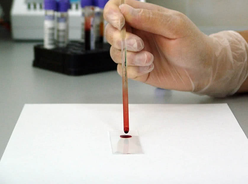 Cientista realizando exame de sangue para detectar câncer no laboratório