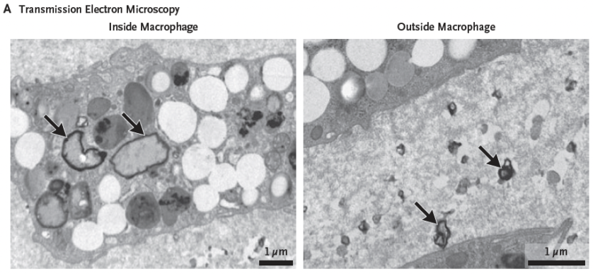 Observaram-se fragmentos irregulares de plástico dentro de células imunológicas conhecidas como macrófagos e em acumulações de gordura extraídas de artérias bloqueadas. (Marfella e colaboradores, NEJM, 2024)